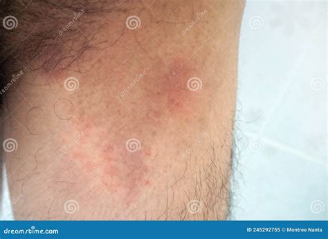 Itchy Rash in the Groin Area. Tinea Cruris is a Type of Skin Disease that Occurs in the Groin ...