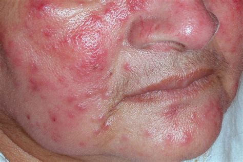 Can You Identify These 13 Common Skin Rashes?