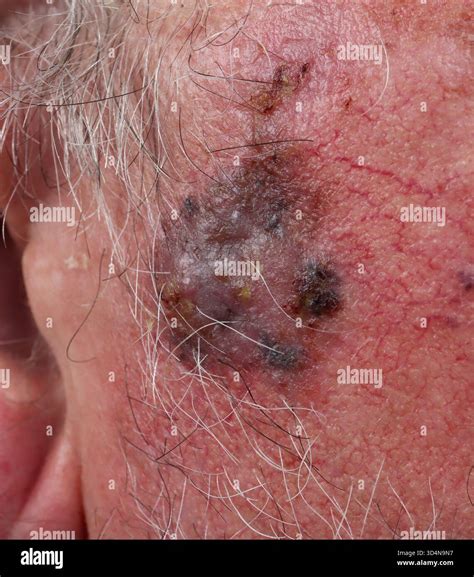 Pre-tragic SSM melanoma, Clark level 4, 2.1mm thick according to Breslow thickness, in a 76-year ...