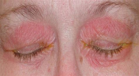 Rash on Eyelid - Pictures, Causes and Treatment