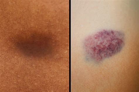 How to Gauge Age of Bruise Based on Color