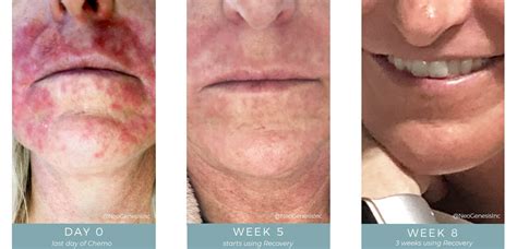 Topical Chemotherapy Side Effects using Fluorouracil (FU5)