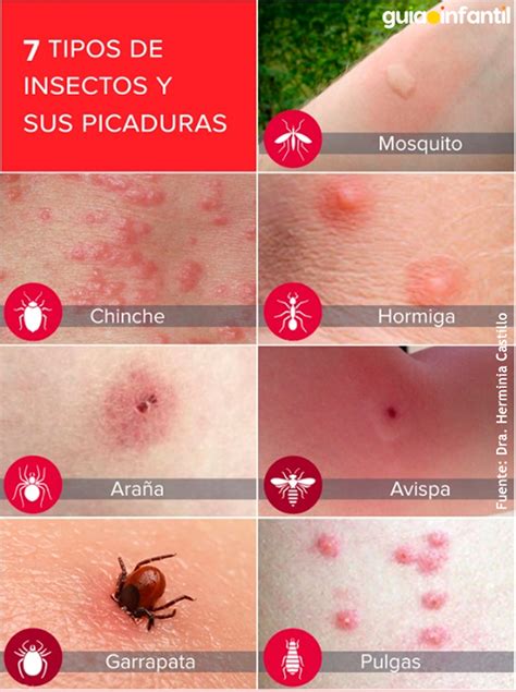 Picaduras De Insectos