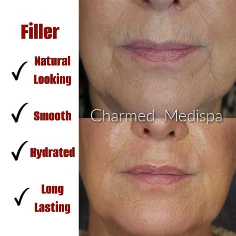 Achieve Natural Facial Balancing of the Lower Face with Dermal Fillers at Charmed Medispa in ...