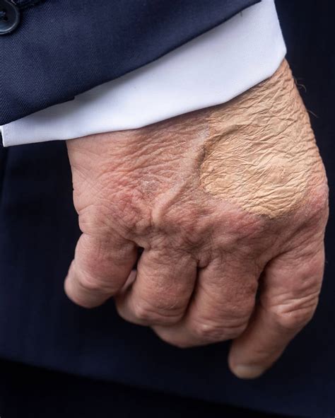 Trump Has Chronic Venous Insufficiency: What This Means • Over Here New ...