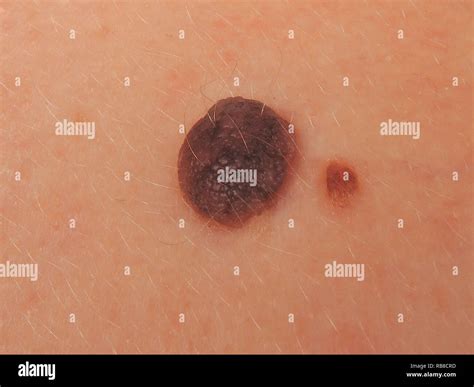 Intradermal Nevus Symptoms Causes And Treatments