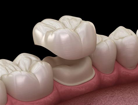Complete Dental Crown Guide: Cost, Procedures, And Types