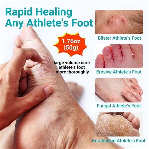 LMNOOP Athletes Foot Treatment Cream Maximum Strength - Antifungal Foot ...