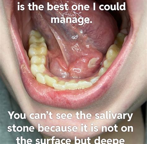Salivary Stone NSFL: Salivary Stones Are Even More Disgusting Than