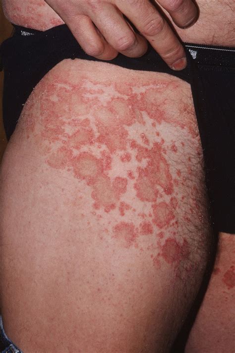 Pityriasis Rosea – 糠疹 写真 : Pityriasis rosea – SDXWV