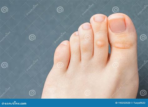 Infected corn on little toe. Pinky Toe Corn: Causes, Treatments, and Prevention Strategies