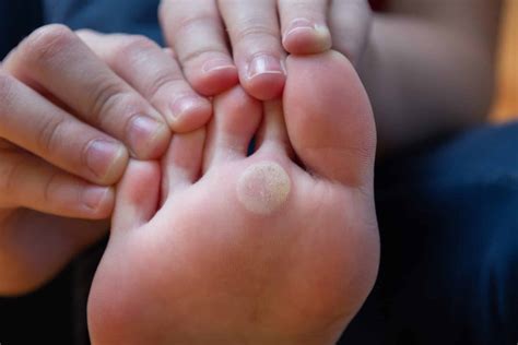 Feet Health Calluses at Daria Willis blog