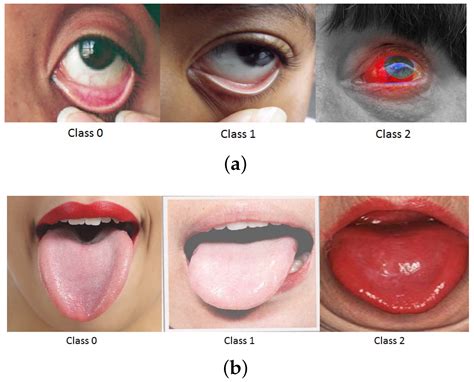 Azure-Based Smart Monitoring System for Anemia-Like Pallor