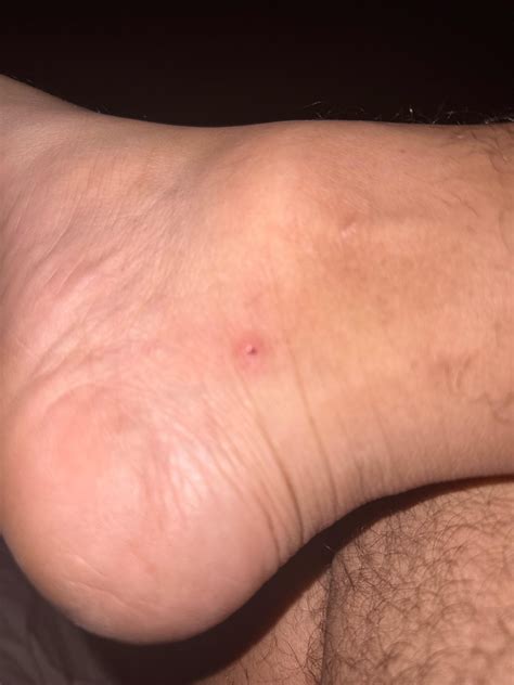 What are these it’s like a red itchy hole I have one on my ankle and leg : r/Dermatology