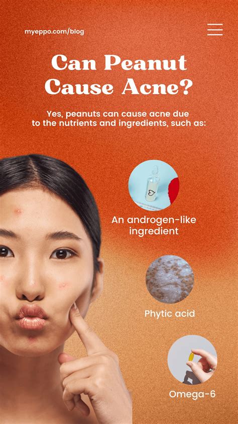 Does Peanut Cause Acne? | myeppo.