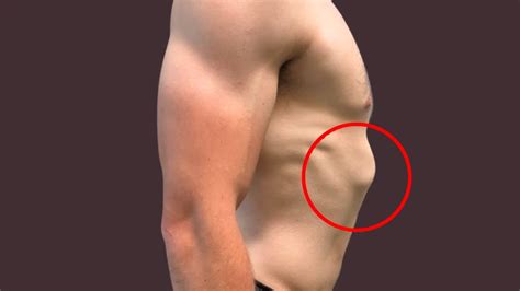 What Are the Causes of Flared Ribs, and How Can They Be Prevented? - Theresa Reviews