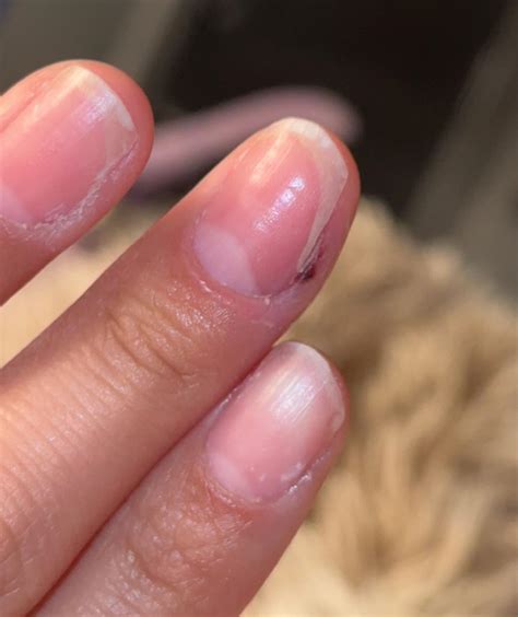 Why Does My Nail Look White at Holly Brough blog