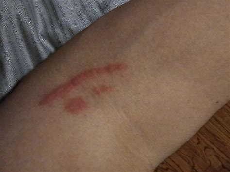 Itchy red line on arm? : r/DermatologyQuestions