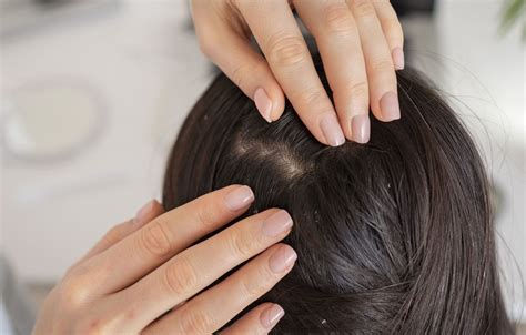 ¿Cómo evitar caída del cabello por psoriasis en la cabeza?