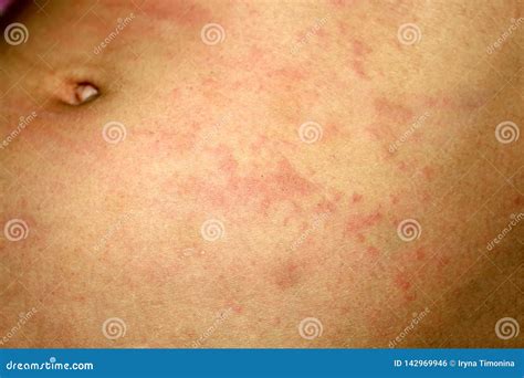 Liquen Rosado En La Piel Del Abdomen Psoriasis, Dermatitis, Eczema, Urticaria, Alergias Foto de ...