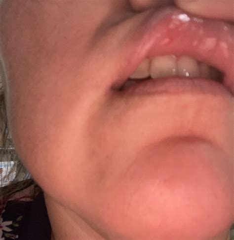Red pimple like bumps inside mouth under top lip my dental appt is Tom ...