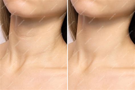Premium Photo | Crease and wrinkles on a womans neck before and after the rejuvenation procedure age