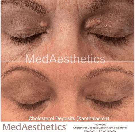 Understanding Xanthelasma: Causes, Symptoms, and Treatment | Medaesthetics - Cosmetic Skin Clinic