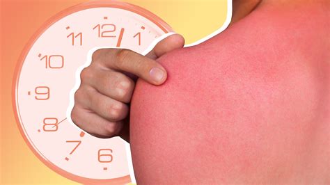 How Long a Sunburn Lasts and How To Treat It