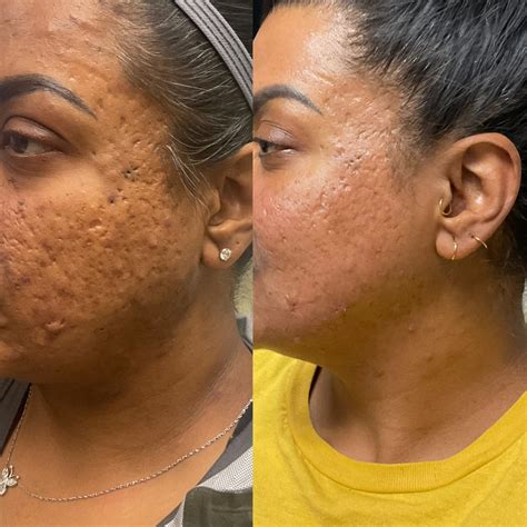Treatment For Enlarged Pores On Face