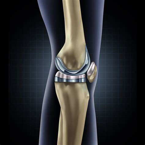 How Successful Is Knee Revision? | Personalized Orthopedics of the Palm Beaches