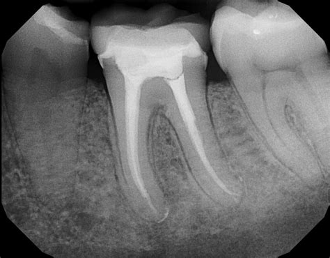 Root Canal Treatment (Endodontic Therapy) - Ideal Dental Care
