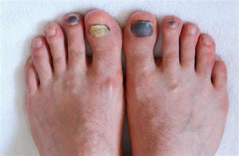 Toenail Fungus: Symptoms & Treatment in Singapore