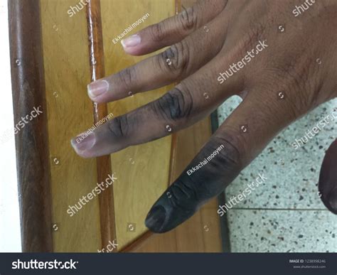 Electrical Burn On Finger