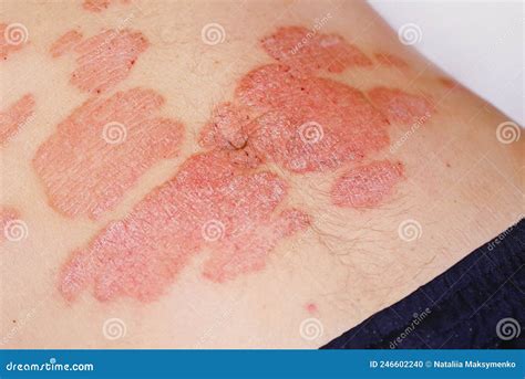 Large Red Inflamed Scaly Rash on the Stomach. Acute Psoriasis on the ...