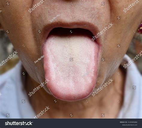 Coated Tongue Sinuses