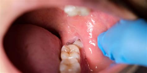 Wisdom Tooth Abscess