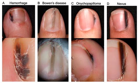 Early Subungual Melanoma