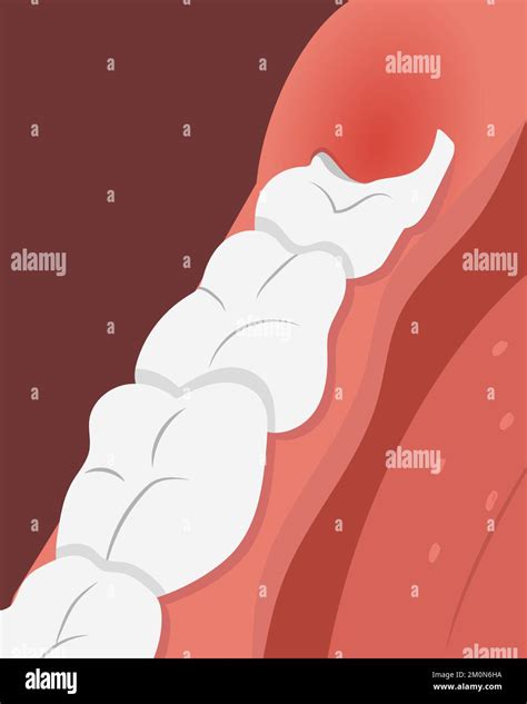 Illustration of teeth row with inflamed gum over the growing wisdom tooth Stock Vector Image ...