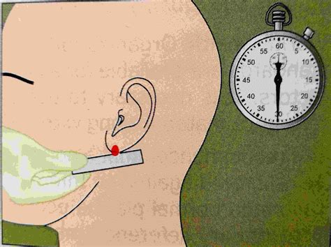 Bleeding Time Test Requirement,principle And Procedure