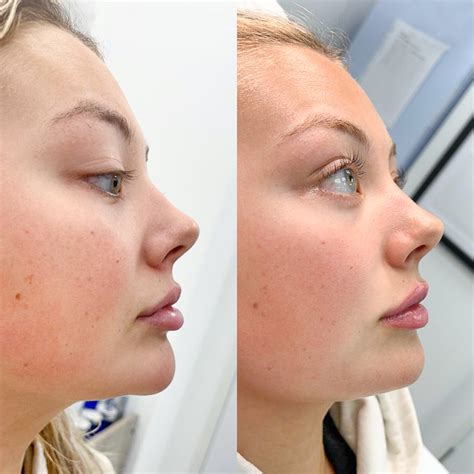 Filler Dissolving - Rejuvenate Clinics