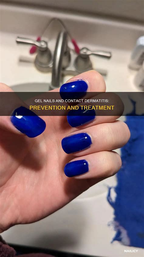 Gel Nails And Contact Dermatitis: Prevention And Treatment | Nailicy