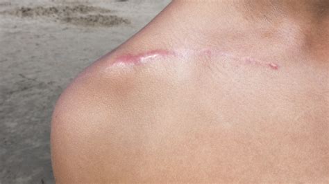 Understanding and Treating Scar Sensitivity: Itching, Pain & Nerve Iss ...