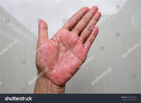 Atopic Dermatitis Ad Known Atopic Eczema Stock Photo (Edit Now) 1790054570