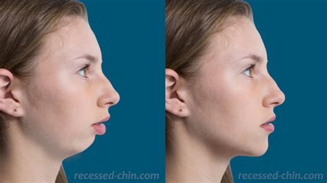 Receding chin photo - Surgical before-and-after simulator