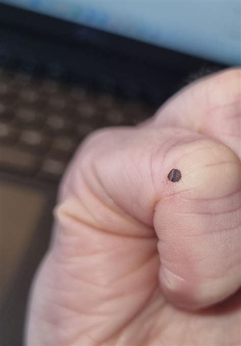Blood blister or? : r/Melanoma