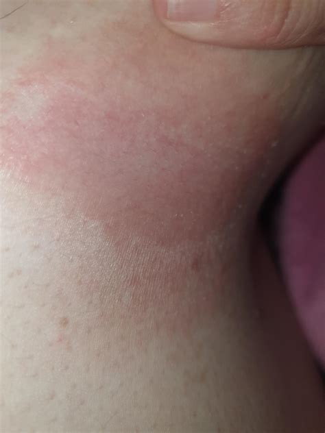 Fungal Rash Under Breast Cream