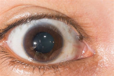 Eye Freckles - Causes, Types & Treatment