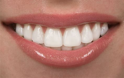 Are Veneers Permanent? Dental Veneers for Beginners - skelabs.com