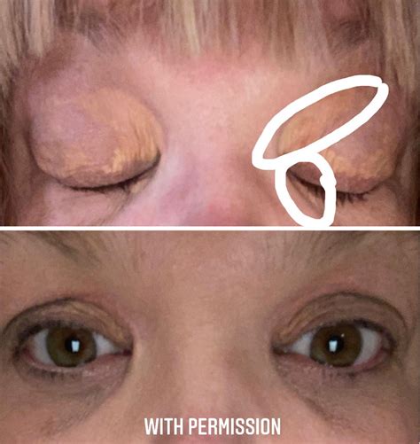 Xanthoma Removal Natural