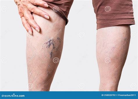 Varicosity. Close Up Of Elderly Feet Of Woman Shows Vascular Asterisks. Rear View. The Concept ...